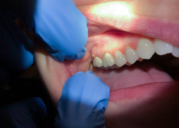 Best Emergency Dental Care for Broken or Chipped Teeth in Montevlo, AL